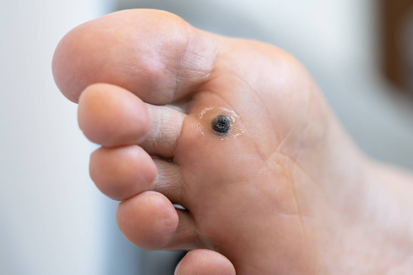 Verruca Treatments