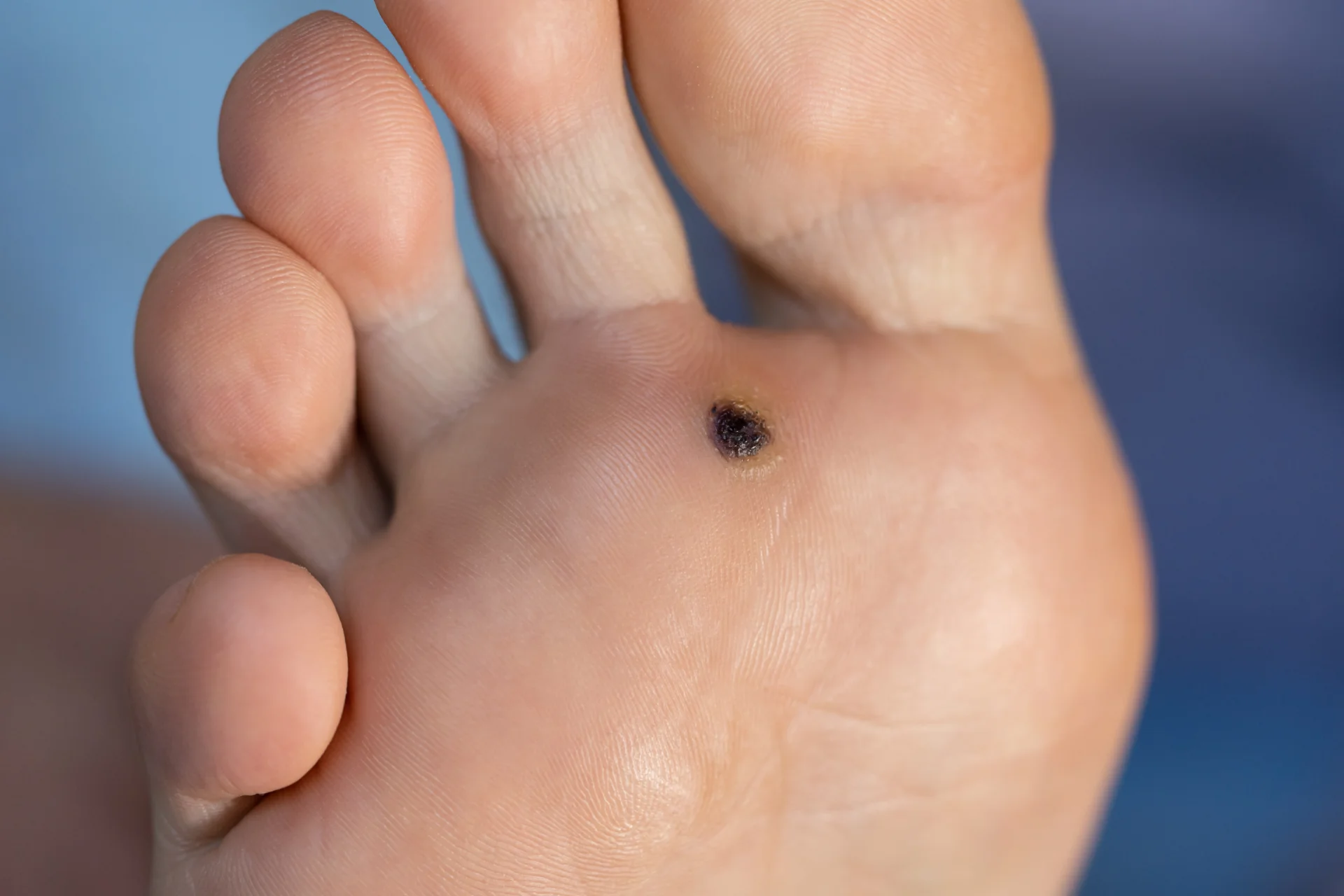 close up of foot with a mole 2026 03 20 06 15 26 utc