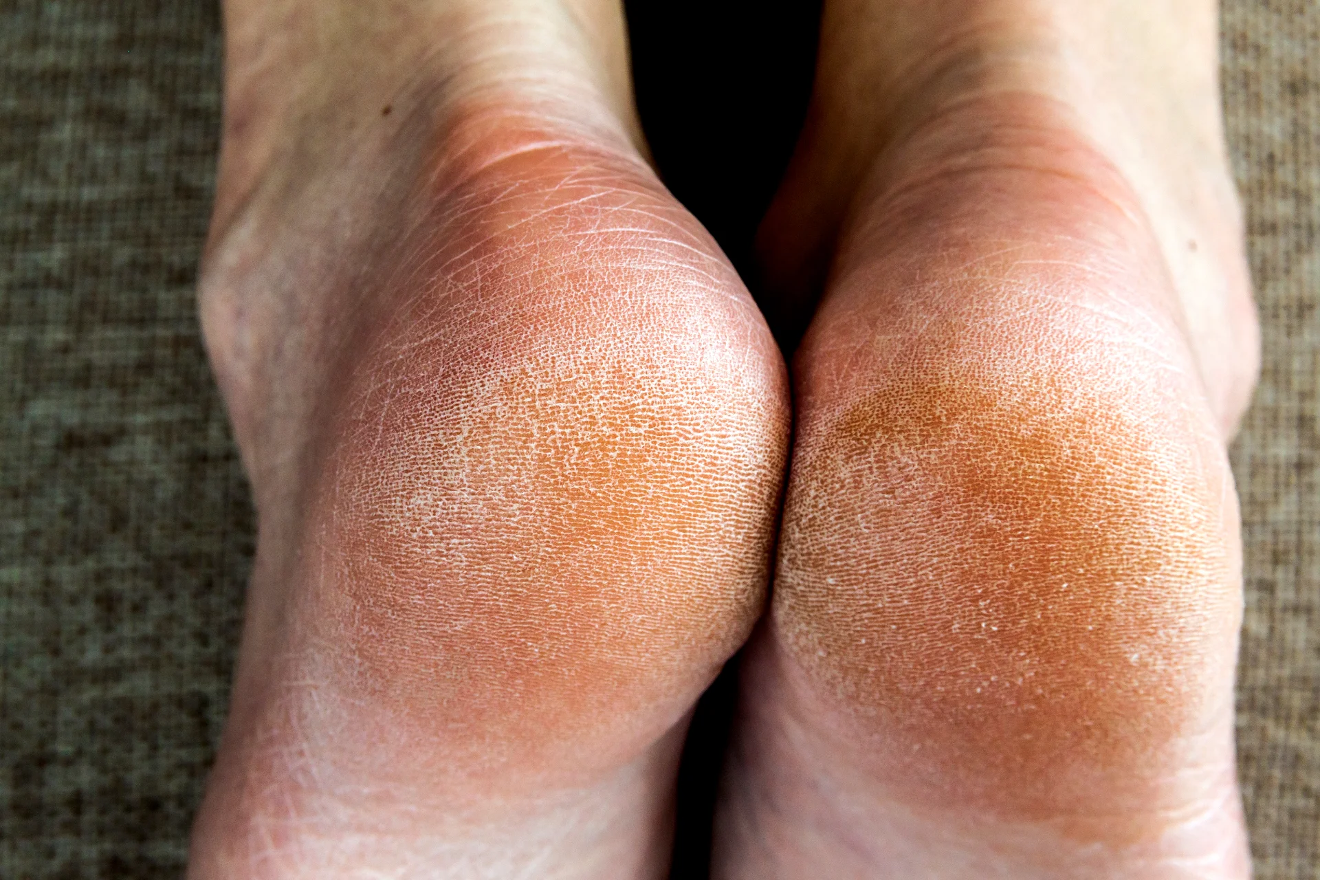 cracked heels showing extreme dryness close up 2026 03 16 02 10 49 utc 1