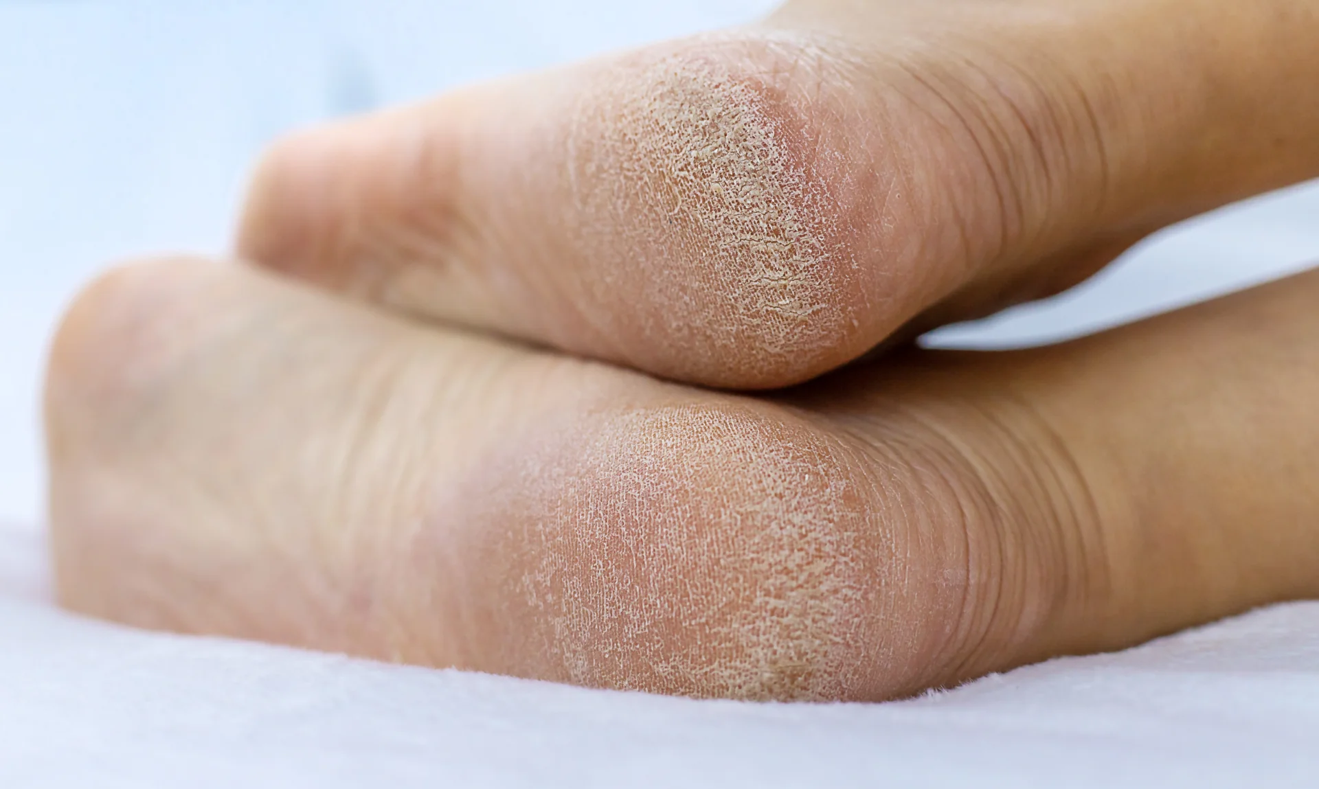 dry cracked heels on white towel close up 2026 03 17 04 17 57 utc